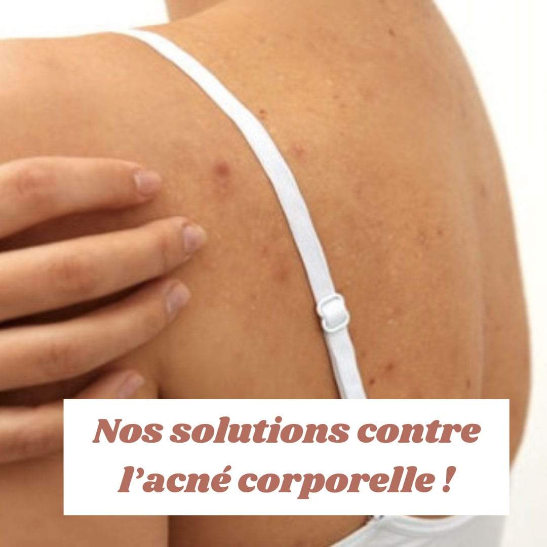 Nos solutions contre l’acné corporelle ! Conseils et astuces beauté ?
